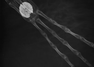 Radiografía de una mano de tres dedos con un implante de metal