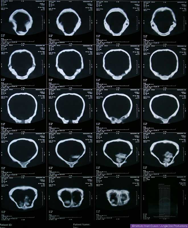 Scanner de l’arrière à l’avant d’une tête « momifiée ».