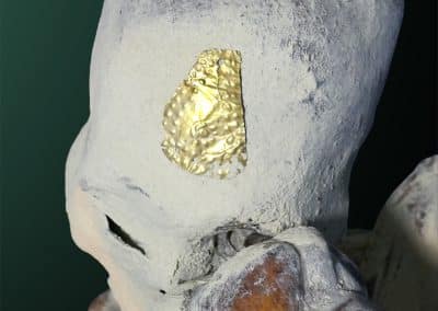La cabeza de Chaska Willakuq y uno de sus implantes metálicos